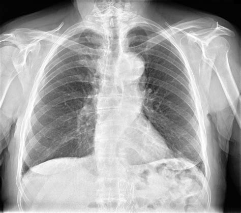 atheromatous aorta x ray|Arteriosclerosis .